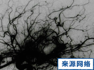 煙霧病 動脈 血管 動脈管腔狹窄