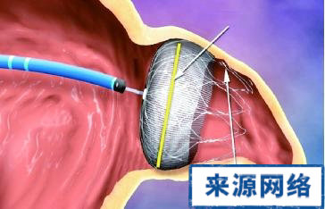 封堵器 治療 先心病 材料