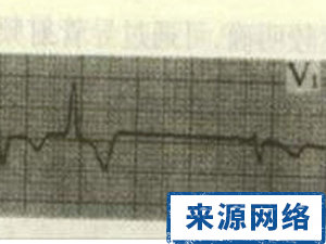 心電圖 窦性心律 異常心電圖 傳導阻滯