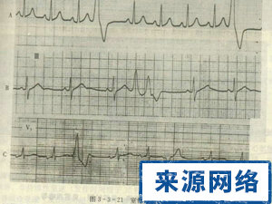 心電圖 窦性心律 異常心電圖 傳導阻滯